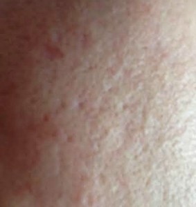 Ice pick and boxcar acne scars